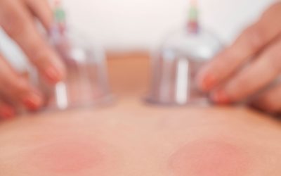 Myofascial Cupping in Lethbridge: Targeted Relief for Pain and Mobility